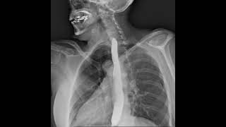 Download lagu Dynamic X-Ray Retrospective View of the Esophagus in Motion | Konica Minolta Healthcare mp3 Download lagu Dynamic X-Ray Retrospective View of the Esophagus in Motion | Konica Minolta Healthcare mp3