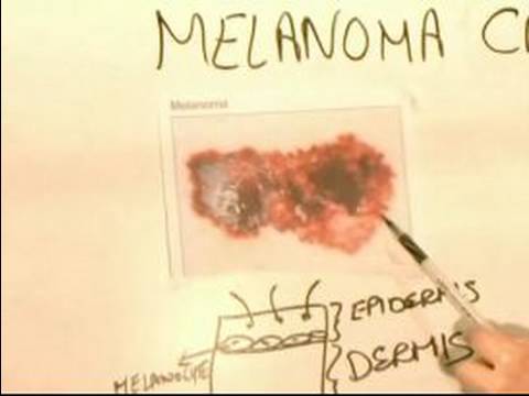 How to Identify Skin Cancer Signs : Signs of Melanoma Carcinoma Skin Cancer