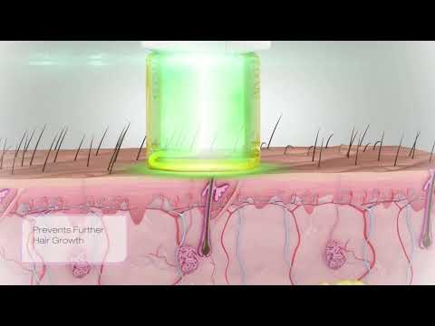 Anpar 755nm 1064nm Long Pulse Laser Hair Removal Working Theory