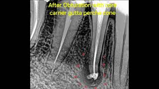 Lesion healing of a tooth with apical bifurcation.