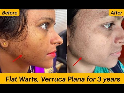 Flat Warts for 3 Years – Case From Kanpur Cured Dr Ravi Singh