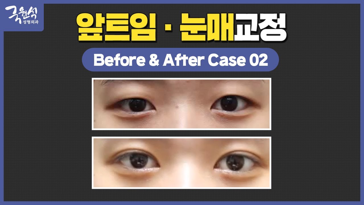 앞트임과 눈매교정 쌍꺼풀 썸네일