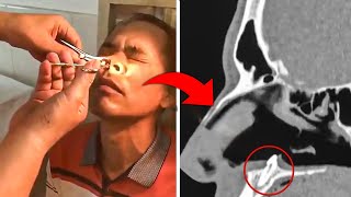 Doctors Find What's Growing Inside his NOSE, After Man Has Intense Itch For Years !