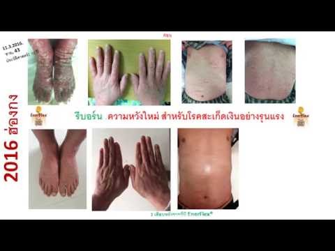 โรคสะเก็ดเงินนาโนครีม ร้องไห้กลากที่ลูกอัณฑะ
