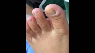 Ep_8471 Foot nails skin removal 👣 ทำไม..หนังถึงเยอะคะ 😄 (clip from Thailand)