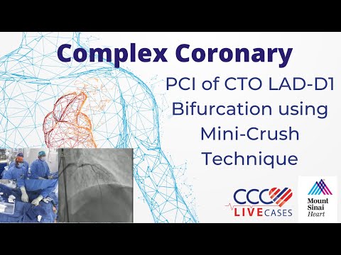 PCI of CTO LAD-D1 Bifurcation using Mini-Crush Technique