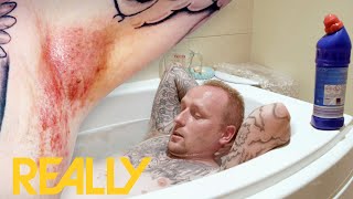 Man Has To Bathe In Bleach To Treat Blisters In The Groin | The Bad Skin Clinic
