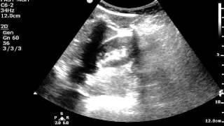 Renal US #importance of fanning