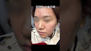 포텐자 시술 후 변화