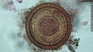 Doctors Pull Live Parasite From California Student's Brain - Newsy