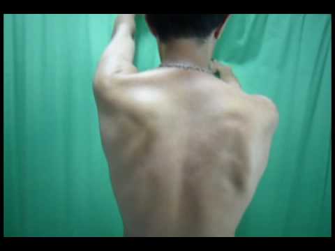 Scapulothoracic Anomalous Motion