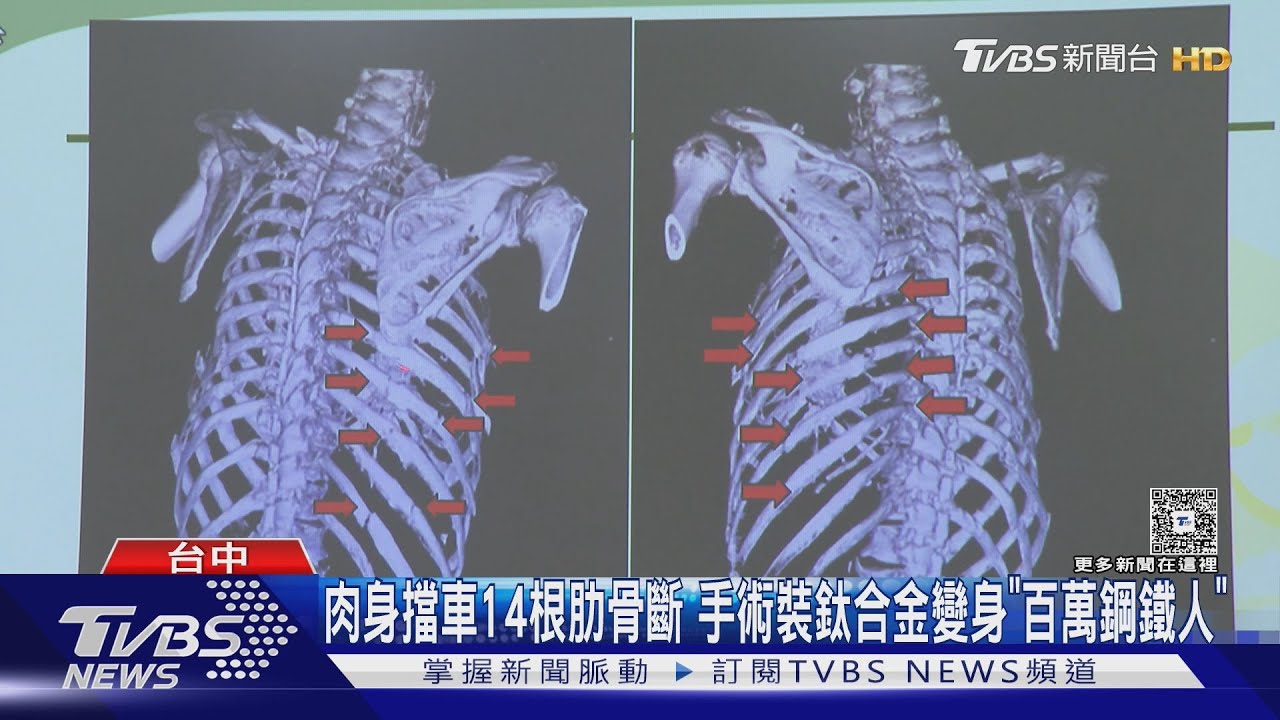 肉身擋車14根肋骨斷!手術裝鈦合金變身「百萬鋼鐵人」