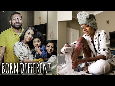 EB Sufferer Proves Doctors Wrong By Having A Family | BORN DIFFERENT