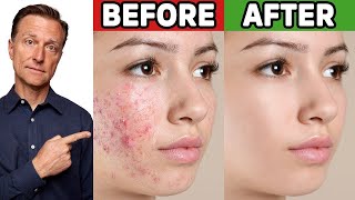 The Best Trick for Clear Skin (Acne, Aging, Wrinkles, Liver Spots)
