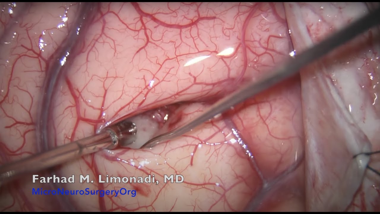 Putar video Brain tumor surgery in a lady who was paralyzed because of the tumor. sekarang Brain tumor surgery in a lady who was paralyzed because of the tumor.
