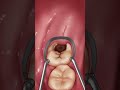 給爛牙補個牙 一分鐘看完補牙全過程 #dentist #牙齒 #口腔健康