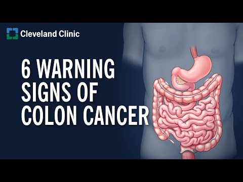 Colon Cancer: Symptoms, Stages & Treatment