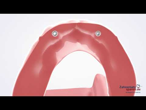 Behandlungsablauf: Kugelkopfprothese - Zahnersatzsparen.de