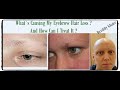 Sudden Loss Of Eyebrow Hair