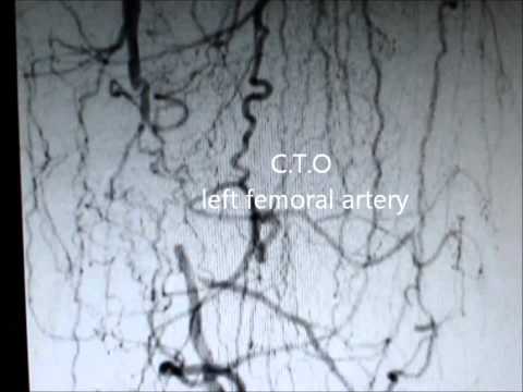 PTA EXT. ILIAC & C.T.O S. FEMORAL ARTERY