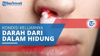 Mimisan, Pendarahan dari Bagian Dalam Hidung yang Sering Disebut Juga dengan Epistaksis