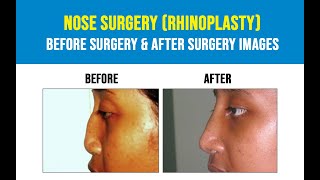 Best Nose Surgery in Hyderabad, Rhinoplasty Cost | Dr Y V Rao Clinics | DOWNLOAD THIS VIDEO IN MP3, M4A, WEBM, MP4, 3GP ETC