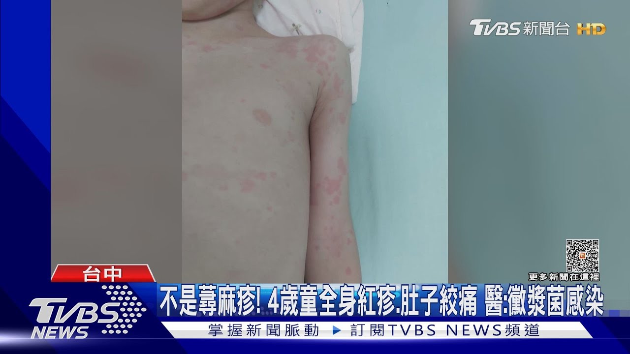 不是蕁麻疹!4歲童全身紅疹、肚子絞痛 醫:黴漿菌感染