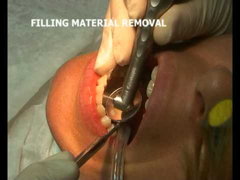 Composite Filling Material Removal with Dental Laser