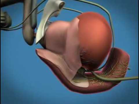 Rektale Zäpfchen für Prostatitis Schmerzen in Prostatatumoren