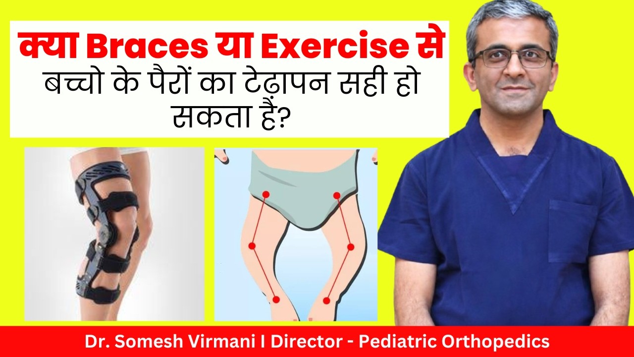 ✅क्या बच्चों के पैरों के टेढ़ापन Exercise से ठीक हो सकता है? | Bow Legs | Dr. Somesh Virmani