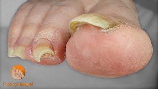 Patient close to 90 years old with osteoarthritis plus visual and motor difficulties | Podology