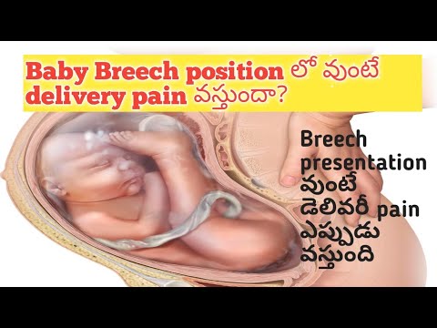 బిడ్డ breech position లో వుంటే నొప్పులు వస్తాయా?can feel delivery pain if baby breech position