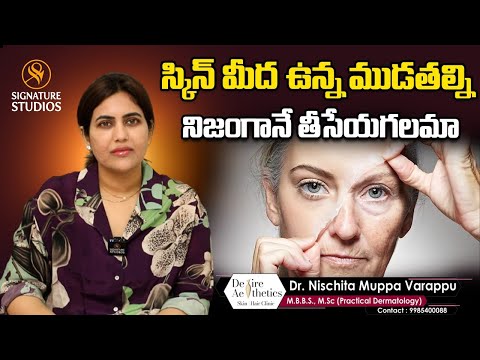 CAN WE REMOVE FACE CURLINGS | DR NISCHITA MUPPAVARAPU | DESIRE ASTETICS | Signature Studios
