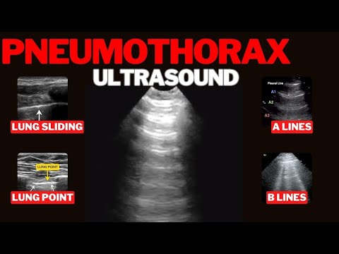 Pneumothorax on Ultrasound
