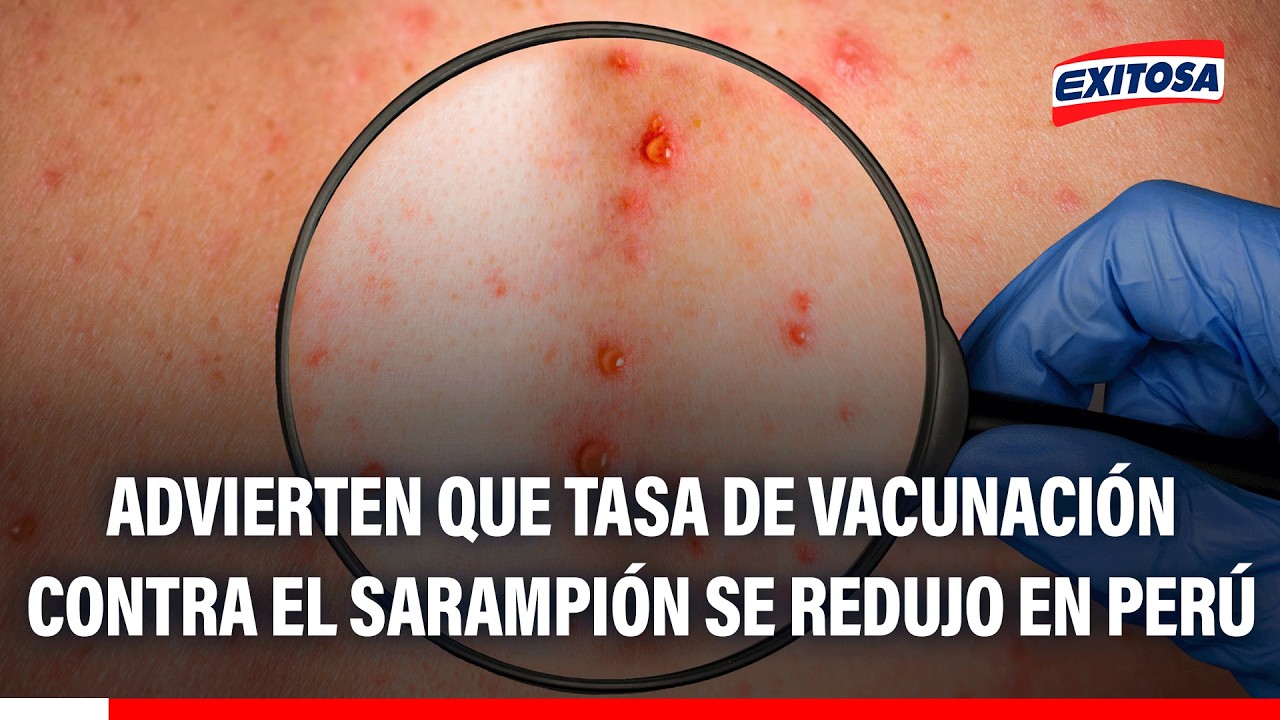 🔴🔵 Advierten que tasa de vacunación contra el sarampión se redujo en Perú