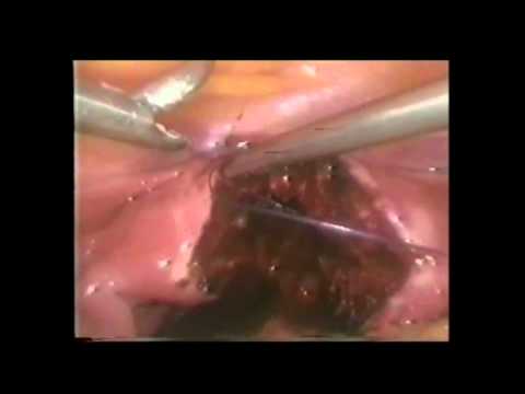 Laparoscopic Strassman Metroplasty for Bicornuate Uterus with Successful Pregnancy