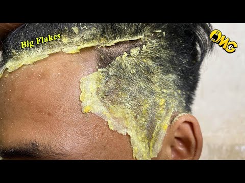 Scratching Dandruff Satisfying Video #132