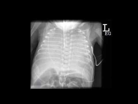 White out lungs 🫁 , severe RDS ,pulmonary haemorrhage ,IDM