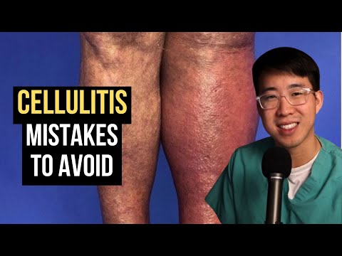How to Treat Cellulitis (Common Mistakes to Avoid)