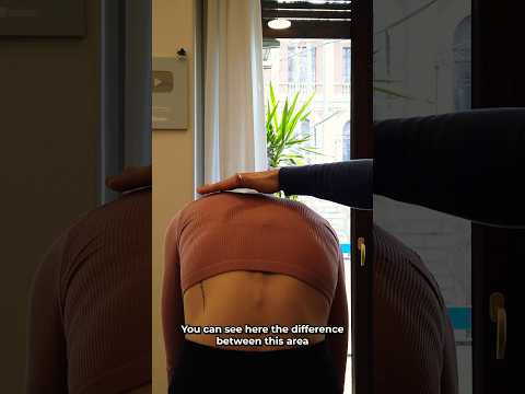 What a Transformation 🤯 Before & After a Scoliosis Treatment #chiropractic