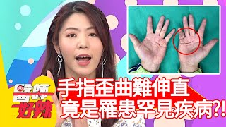 手指歪曲難伸直，竟是罹患罕見疾病？！【#醫師好辣】20210202 part3 EP1094 宋晏仁 林惠鈺