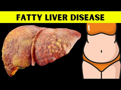 The Ultimate Guide to Understanding Fatty Liver Disease Everything You Should Know About Fatty Liver