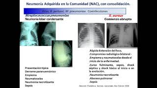 Neumonia Etiologia. Tratamiento Pre Grado.