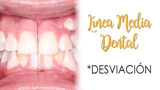 LINEA MEDIA DENTAL | DESVIACIÓN: CAUSAS Y TRATAMIENTO