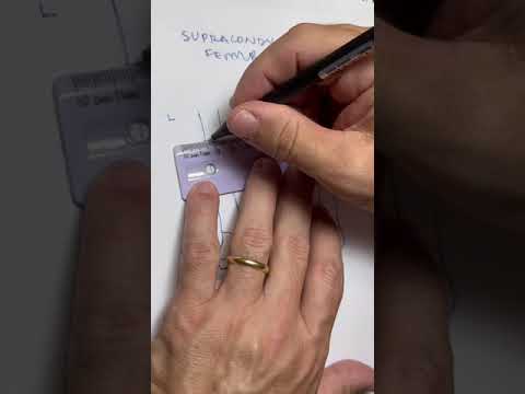 Distal femur supracondylar fracture locking plate fixation drawing.