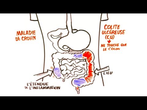 comment guerir inflammation estomac