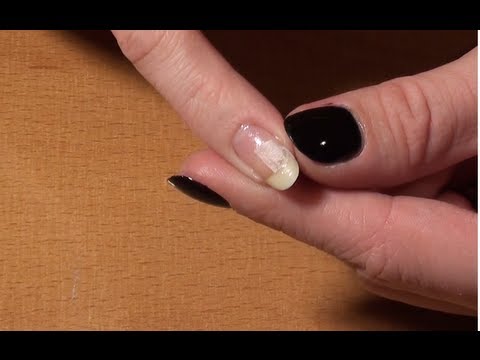 comment réparer ongle cassé