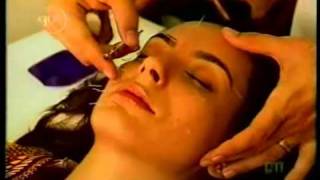 Acupuntura Estética - Estética facial (rugas e flacidez)