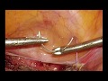 Dr Modi S Needle Holding Tip For Laparoscopic Suturing 9th June 2018