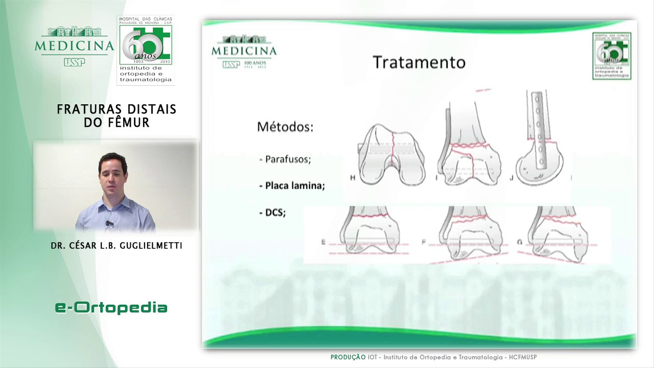 Fraturas Distais do Femur - Dr. Cesar Betoni Gugliemetti